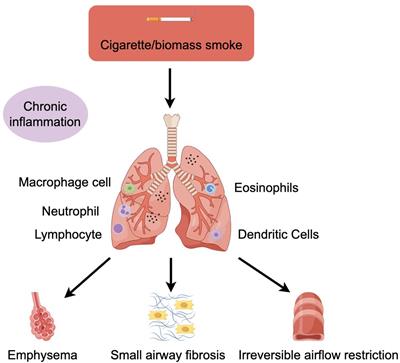 Inflammation mechanism and research progress of COPD